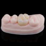 dental crown procedure step-by-step